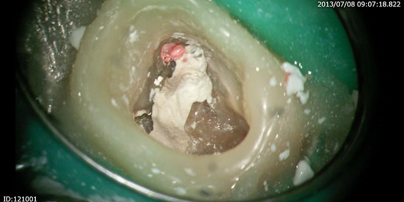 血液のあるところがパーフォレーションです。