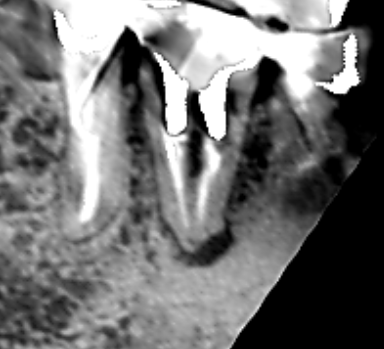 Vol.34　CT画像で歯根破折が疑えたとしても、割れていなかったケース