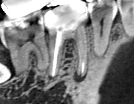 Vol.35　イスムスという根管と根管の間の交通路を清掃して根管充填をしたところ膿が改善したケース