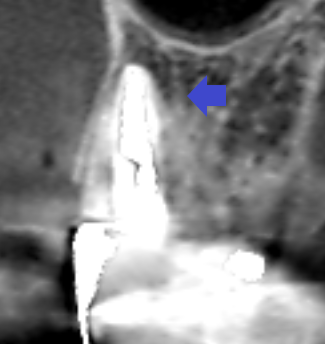 Vol.36　膿が無いように見えて実は膿があったケース