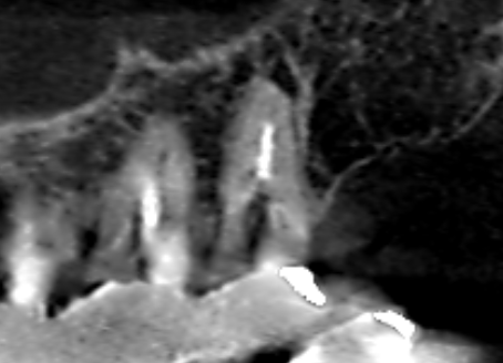 Vol.37　上顎第二大臼歯の口蓋根に膿があり手術ができないケース