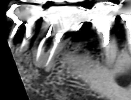 Vol.38　下顎第一大臼歯の近心根に膿がみられたケース