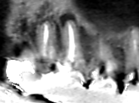 Vol.39　上顎第一大臼歯の近心根に膿がみられたケース