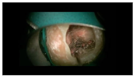 1.破折ファイルが根管内に残留