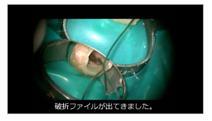 4.破折ファイルが見える