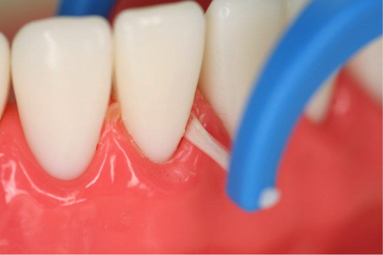 フロスの当て方