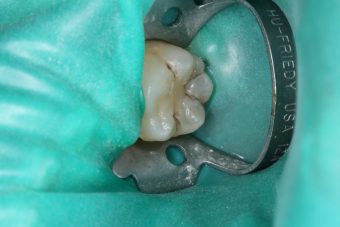 ラバーダム防湿