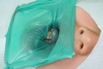 ラバーダム防湿