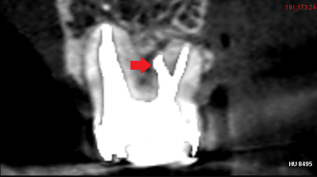 パーフォレーションリペア