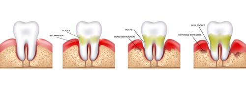 歯周病の進行