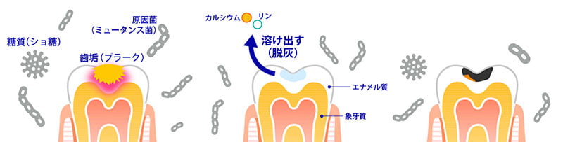 むし歯の成り立ち