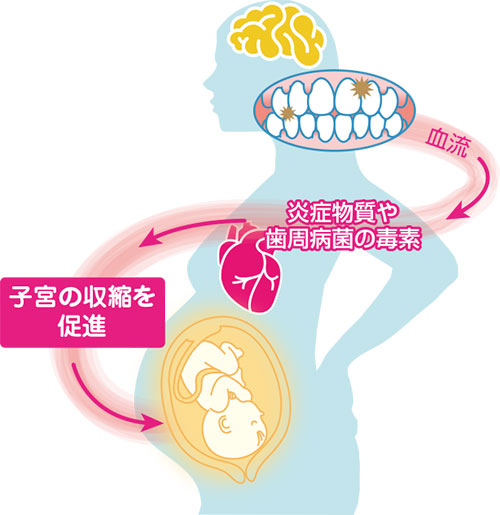 口腔常在菌が全身疾患に及ぼす影響