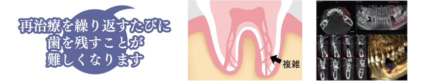 再治療を繰り返すたびに歯を残すことが難しくなります