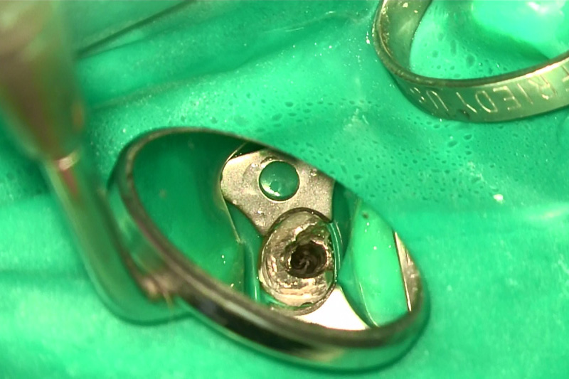 一般的な歯科で使われているルーペ（画像で約2.5倍）で見た小臼歯です。中心の根管部分は暗くて良く見えません。