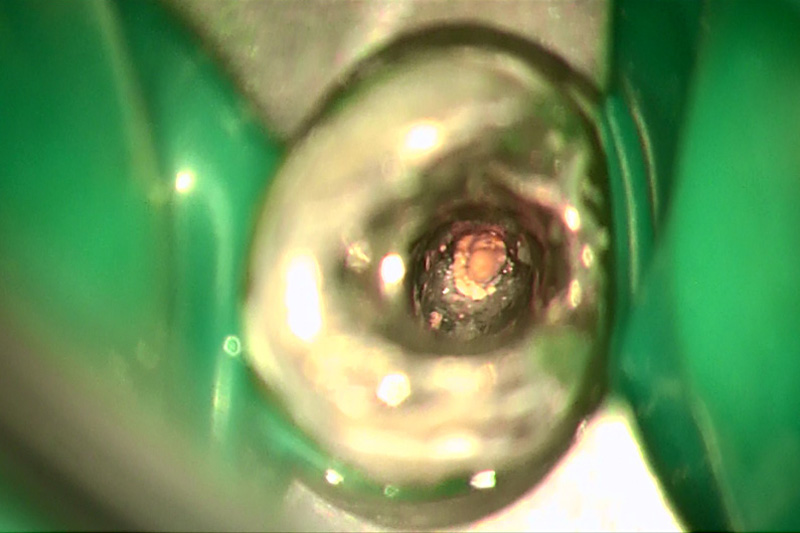 左の歯を、歯科用顕微鏡で拡大して見た画像です。根管に充填されていたピンク色の根管充填材がはっきり確認できます。