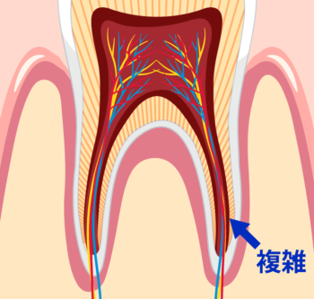 根管治療