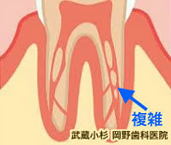 根管治療