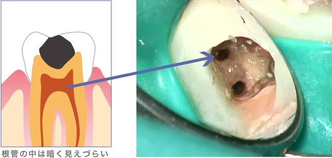 根管の中