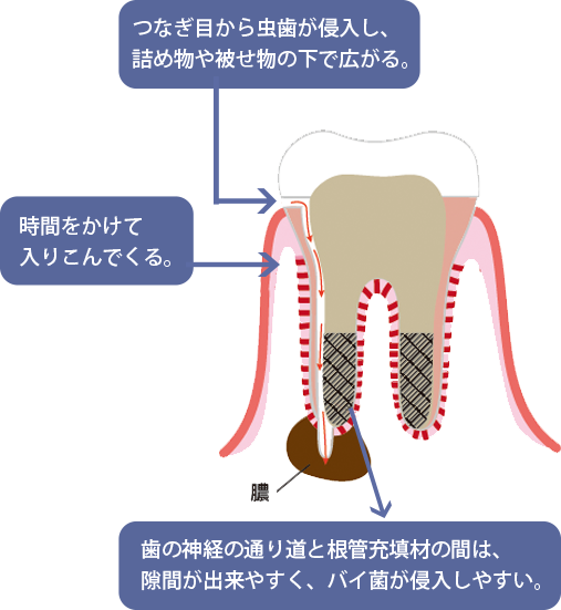 根管の様子