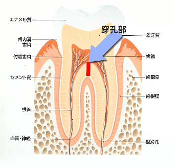 穿孔部