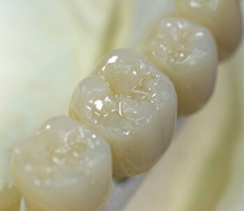 白い歯の材質・適合性の問題