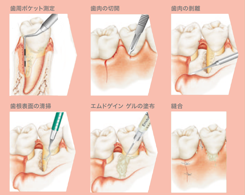 重度の歯周病治療