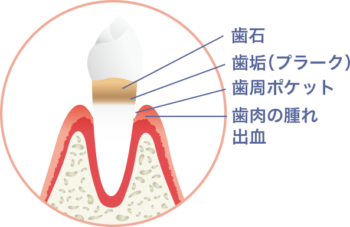 歯周病