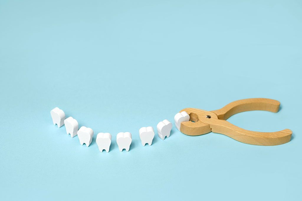 【虫歯再発の転帰】再発してしまったら歯はどうなる？