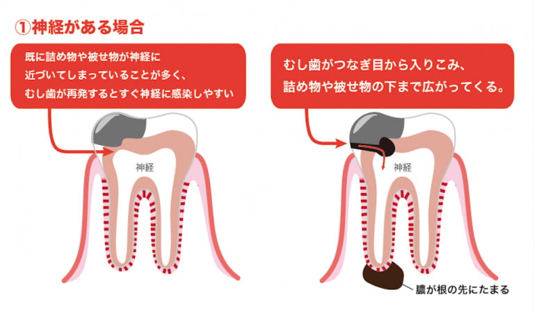 むし歯の治療後（歯の神経がある場合）