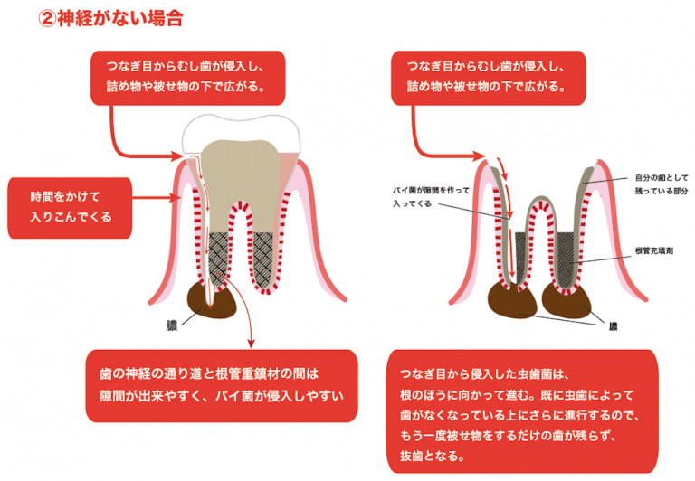 むし歯の治療後（歯の神経がない場合）