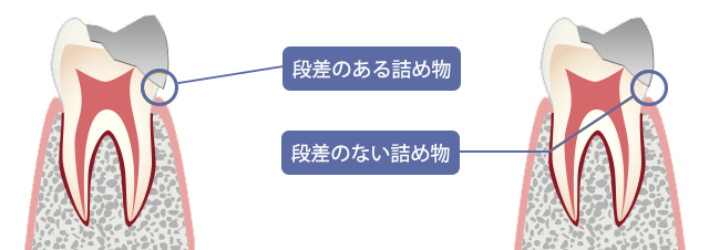 段差のある詰め物、段差のない詰め物