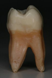 歯根が露出している部分